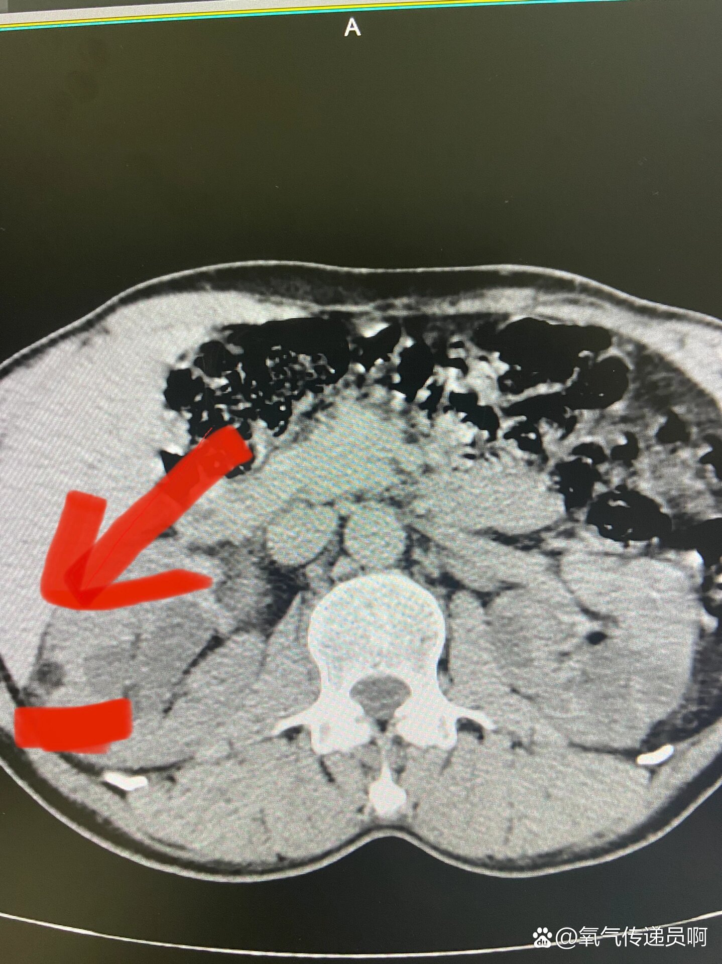 肾错构瘤(肾平滑肌脂肪瘤或肾血管肌脂肪)超声下提示为高回声,ct