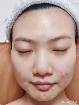 中医面膜(木兰皮栀子粉)后续