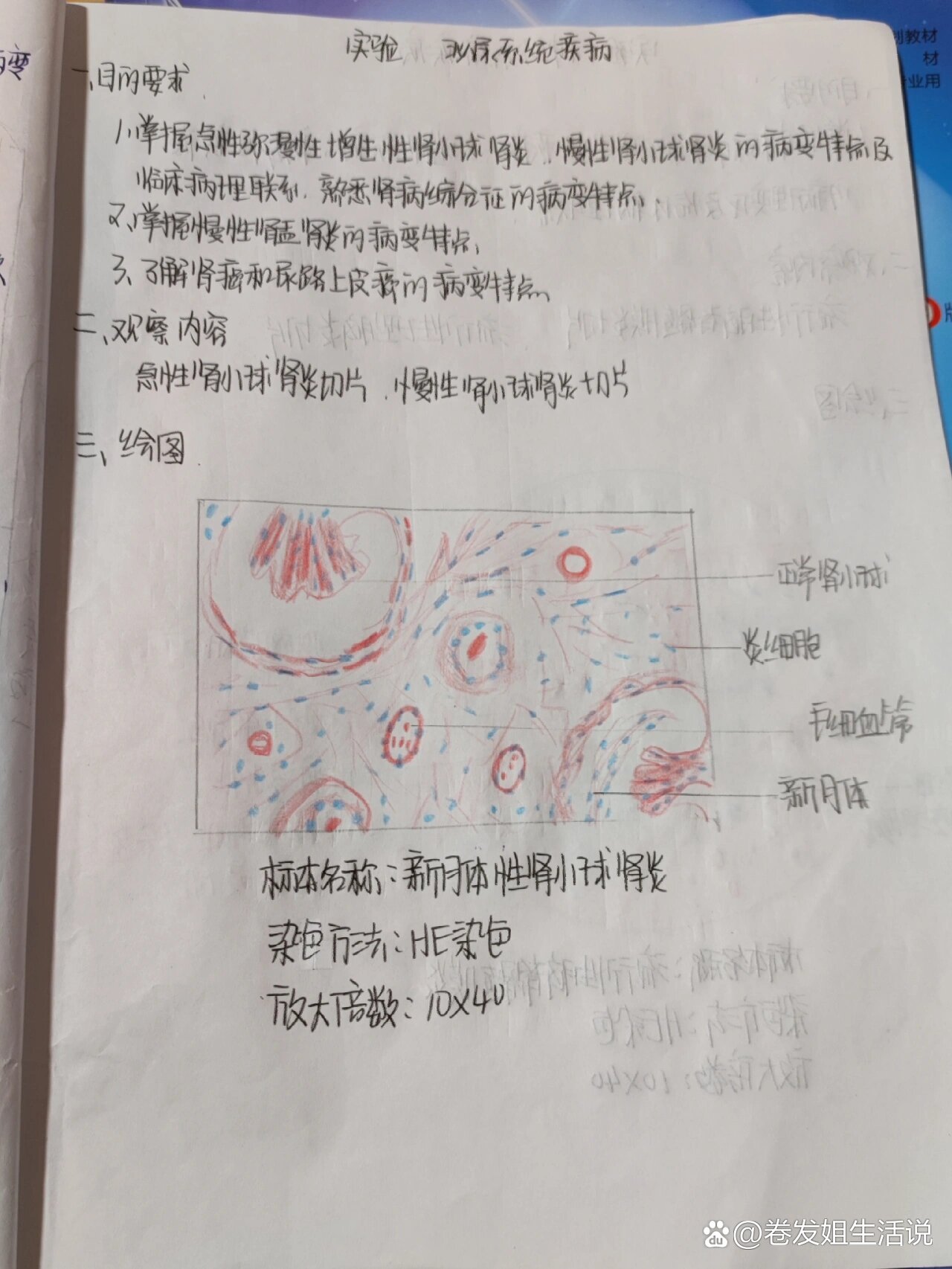 病理新月体性肾小球肾炎红蓝铅笔绘图