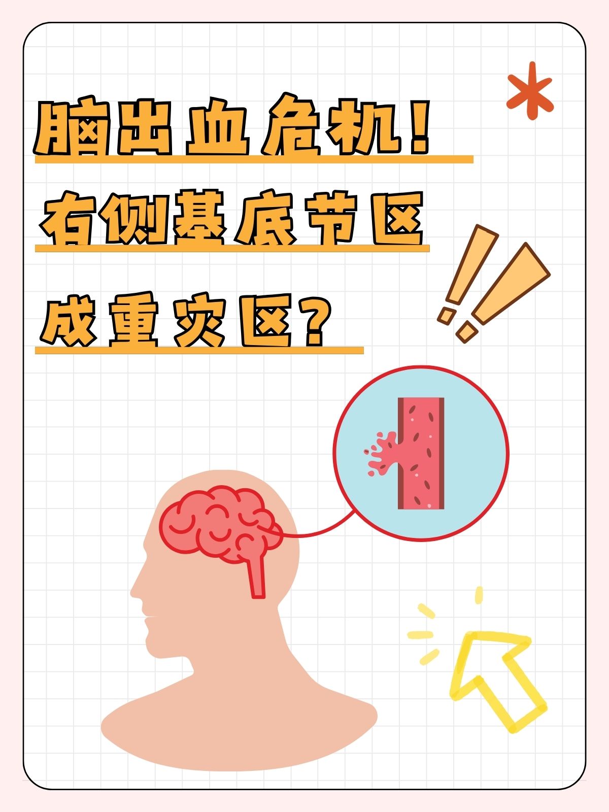 右侧基底节区脑出血,一文带你了解!