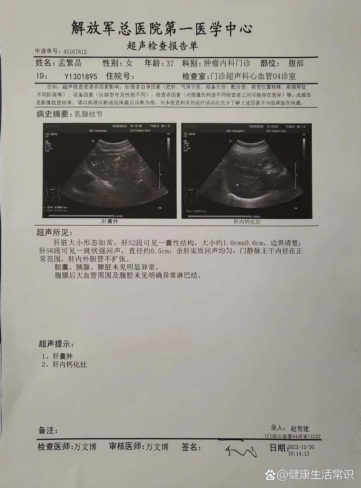 癌化验单沈阳患者到医院检查检查出测速左侧乳房有病一张张报告单子