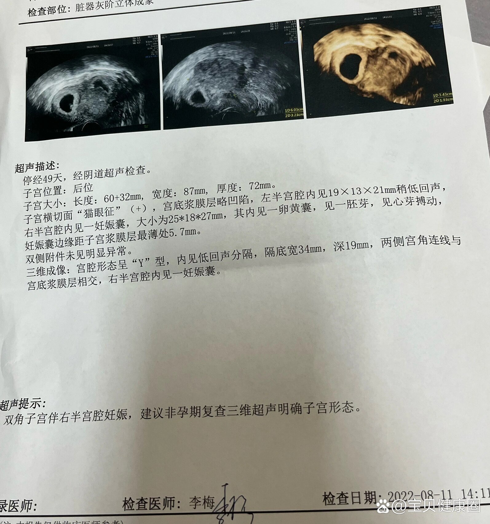 纵隔子宫的姐妹们不要怕
