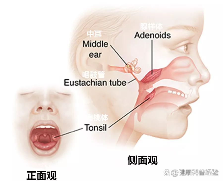 孩子腺样体肥大手术全过程分享