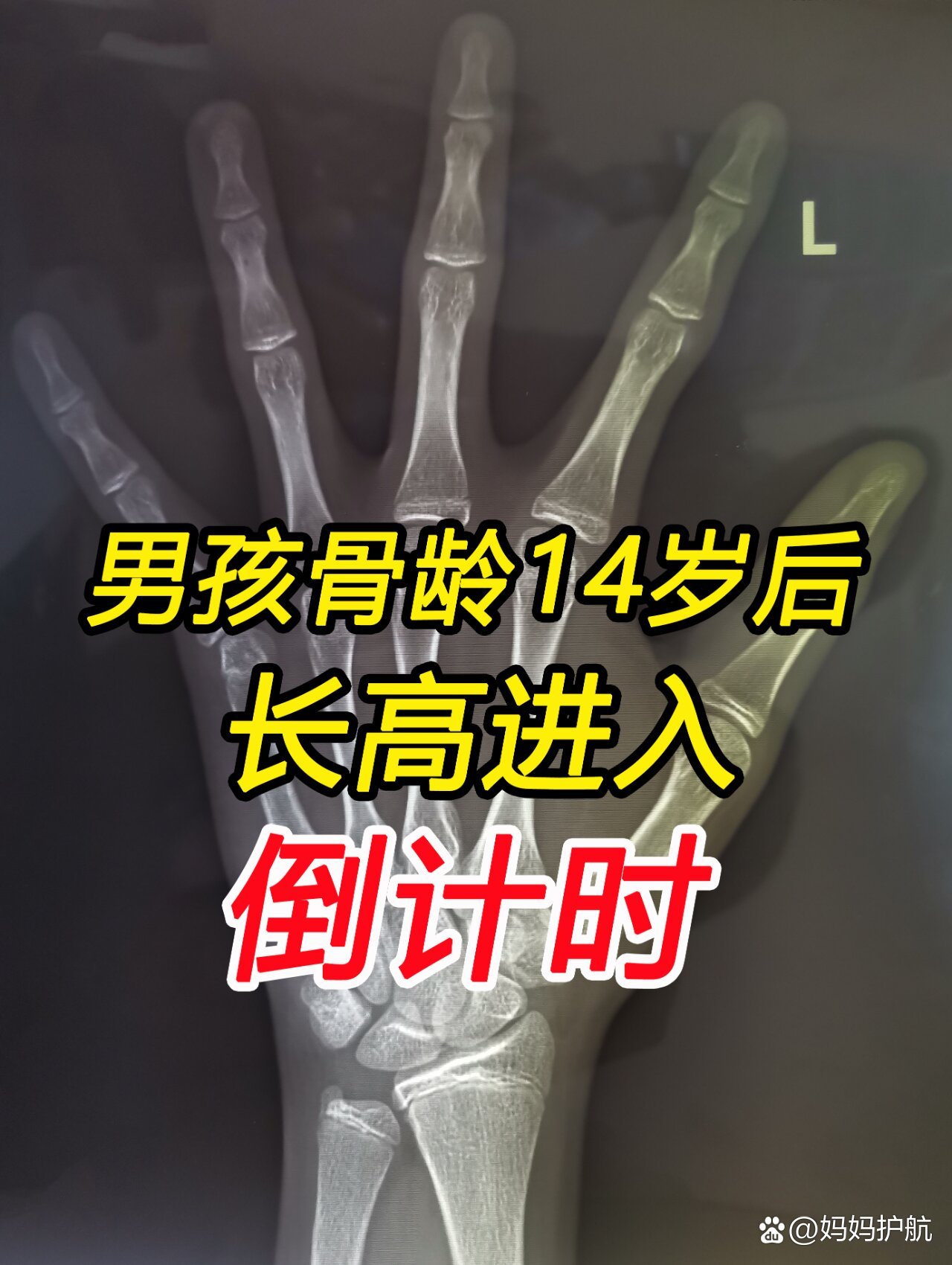 男孩骨龄过了14岁后长高进入倒计时