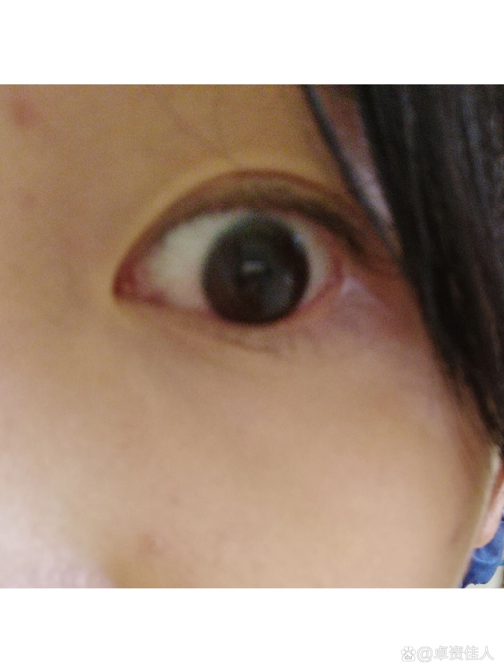 摘完美瞳眼镜很红正常吗