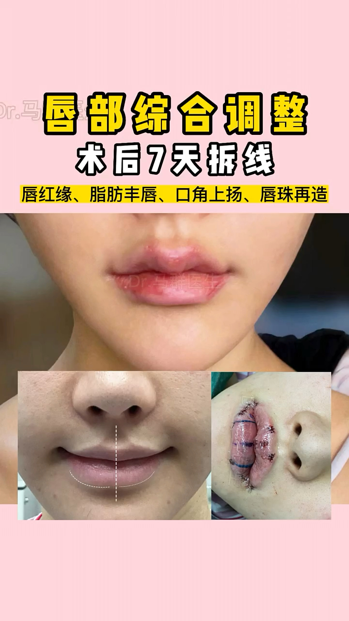 唇综合7天拆线,杨紫同款方形饱满唇