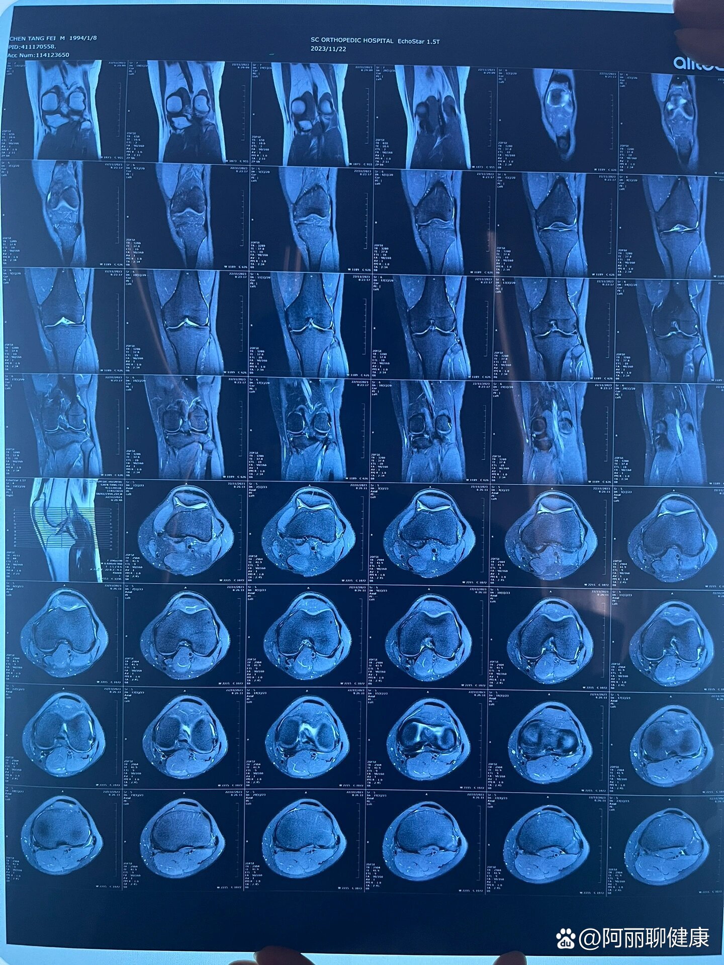 左膝内侧半月板后角撕裂,医生说是三级