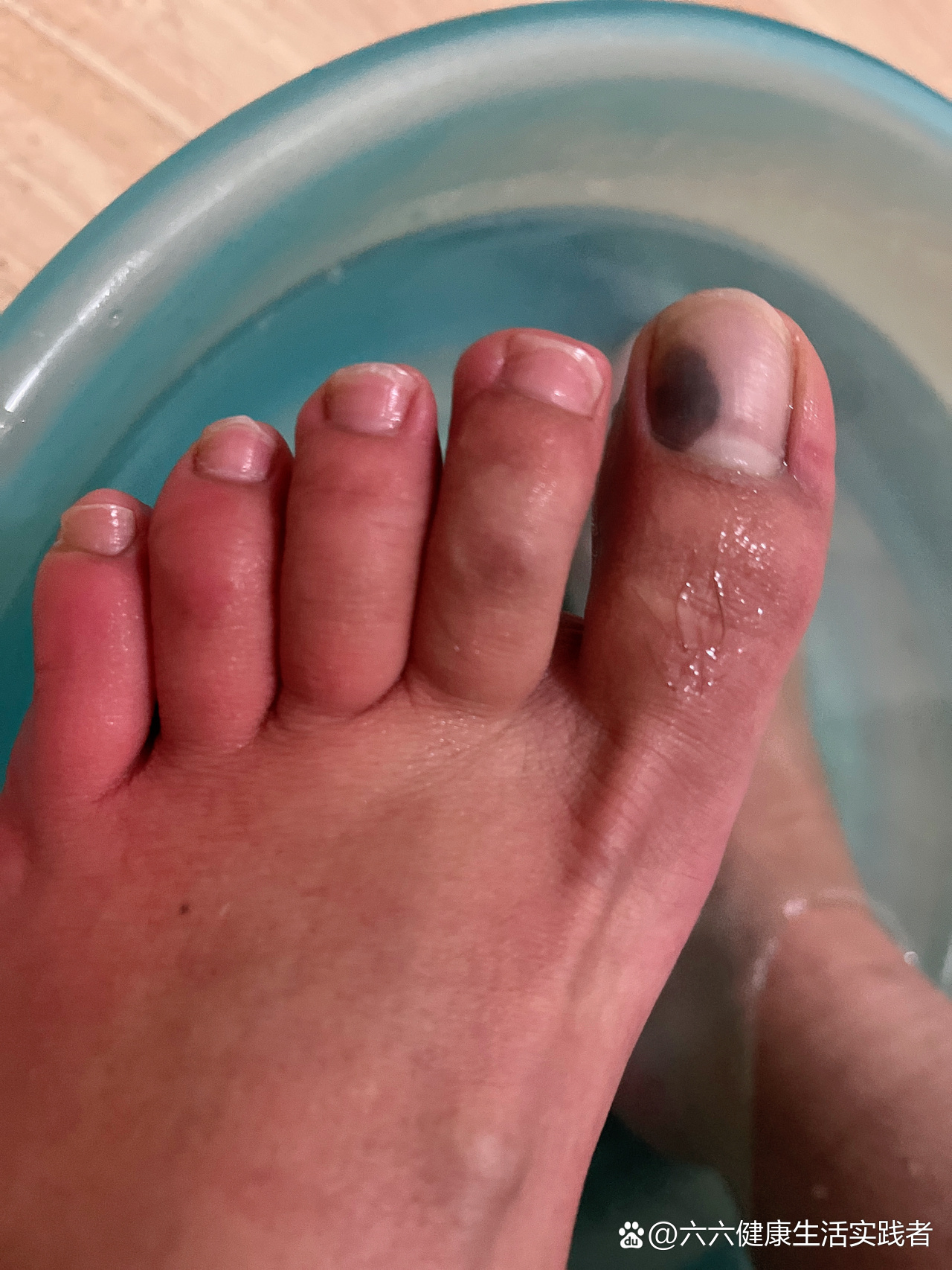 突然脚趾头黑了一块