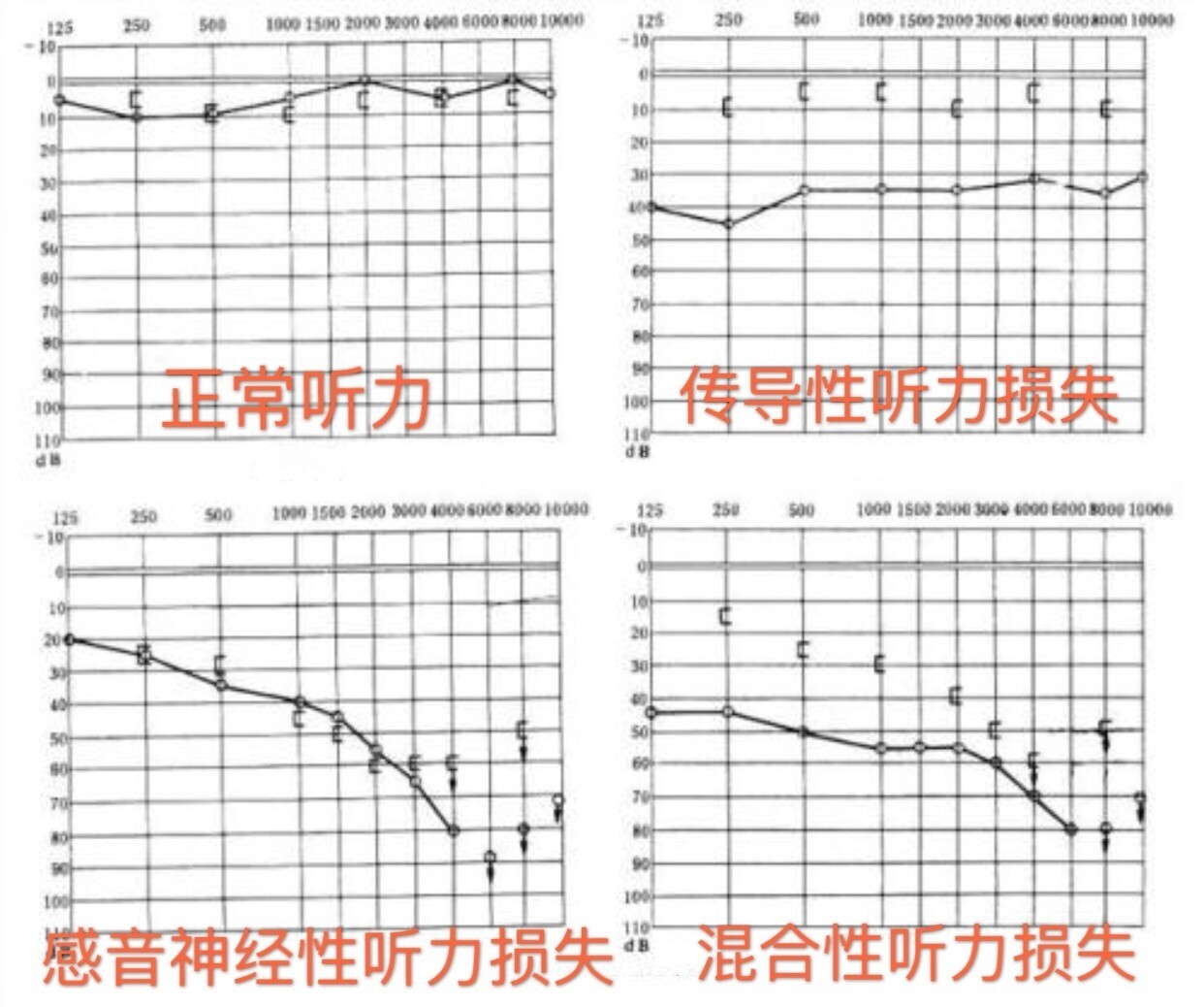 传导性耳聋