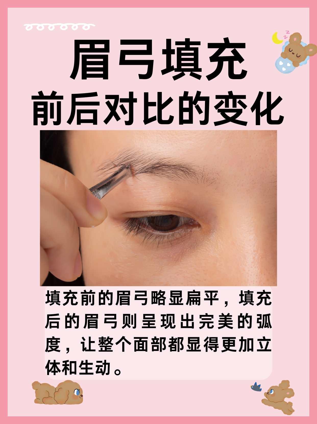 眉弓填充,前后对比惊人