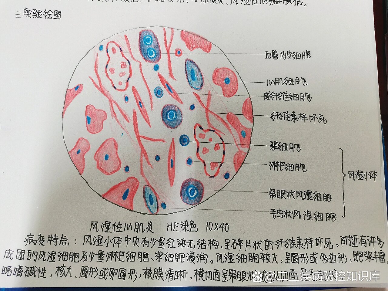 风湿小结图片图片