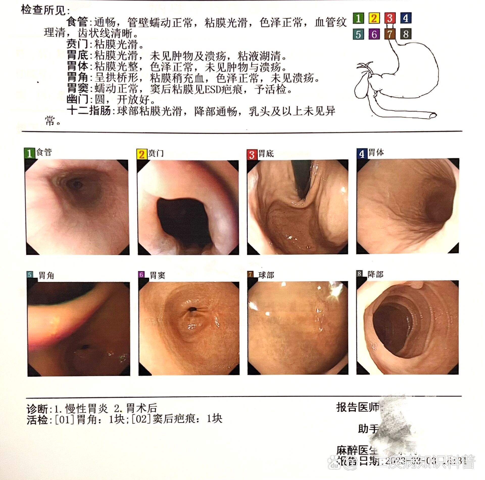 轻度慢性萎缩性胃炎伴肠化逆转慢性浅表性胃