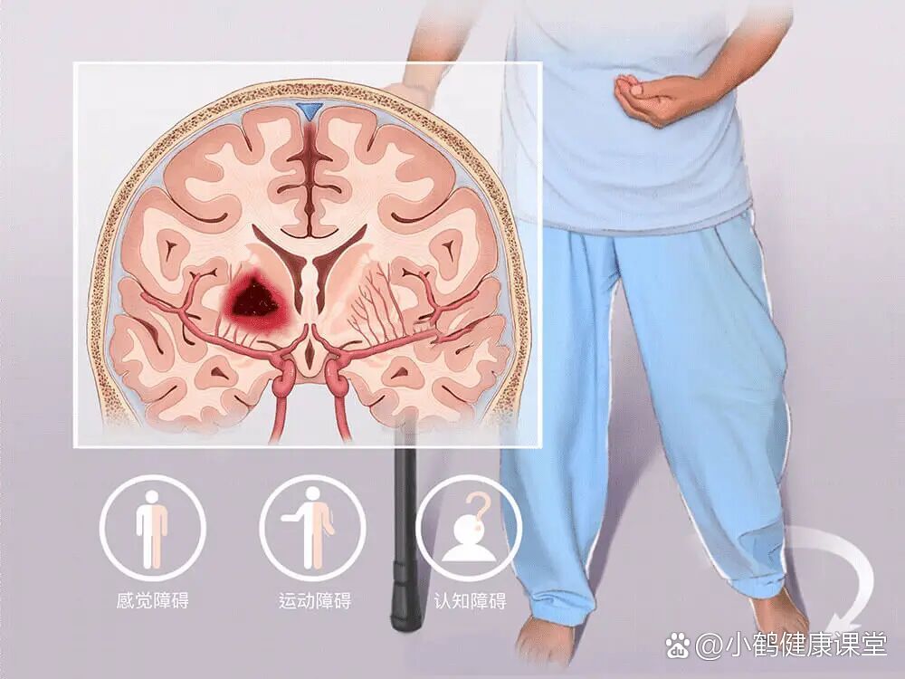 脑出血就算挺过去,可能还要承受4大后遗症