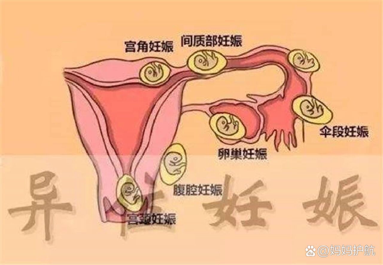 宫外孕的几种类型,看看你是哪一种?