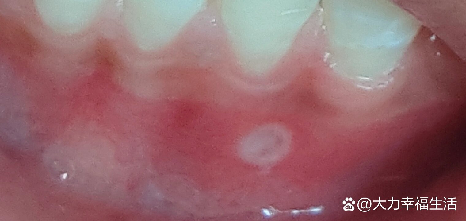 口腔溃疡长在牙龈上