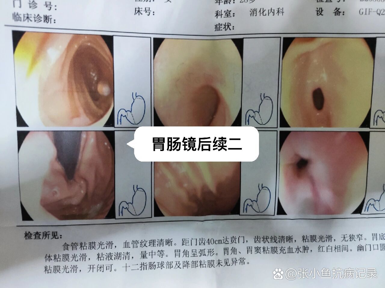 胃肠镜后注意事项