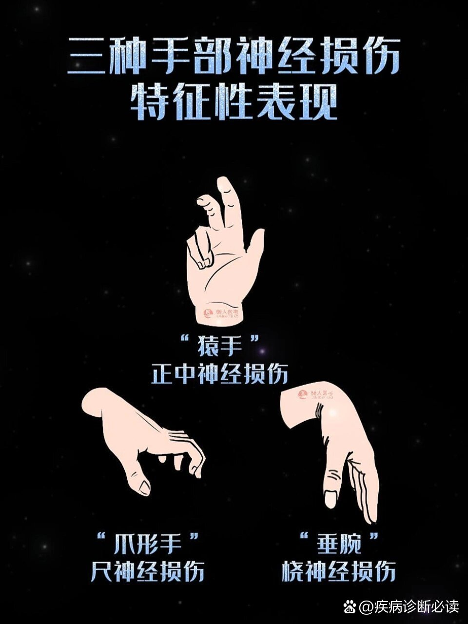  p>手部畸形-神经损伤 br>手部神经损伤:爪形手,猿手,垂腕 br>	 br>桡