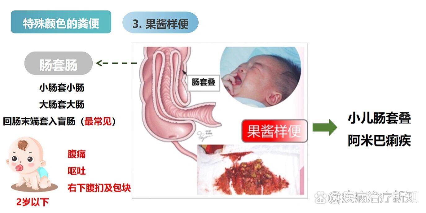 特殊颜色粪便之果酱样便