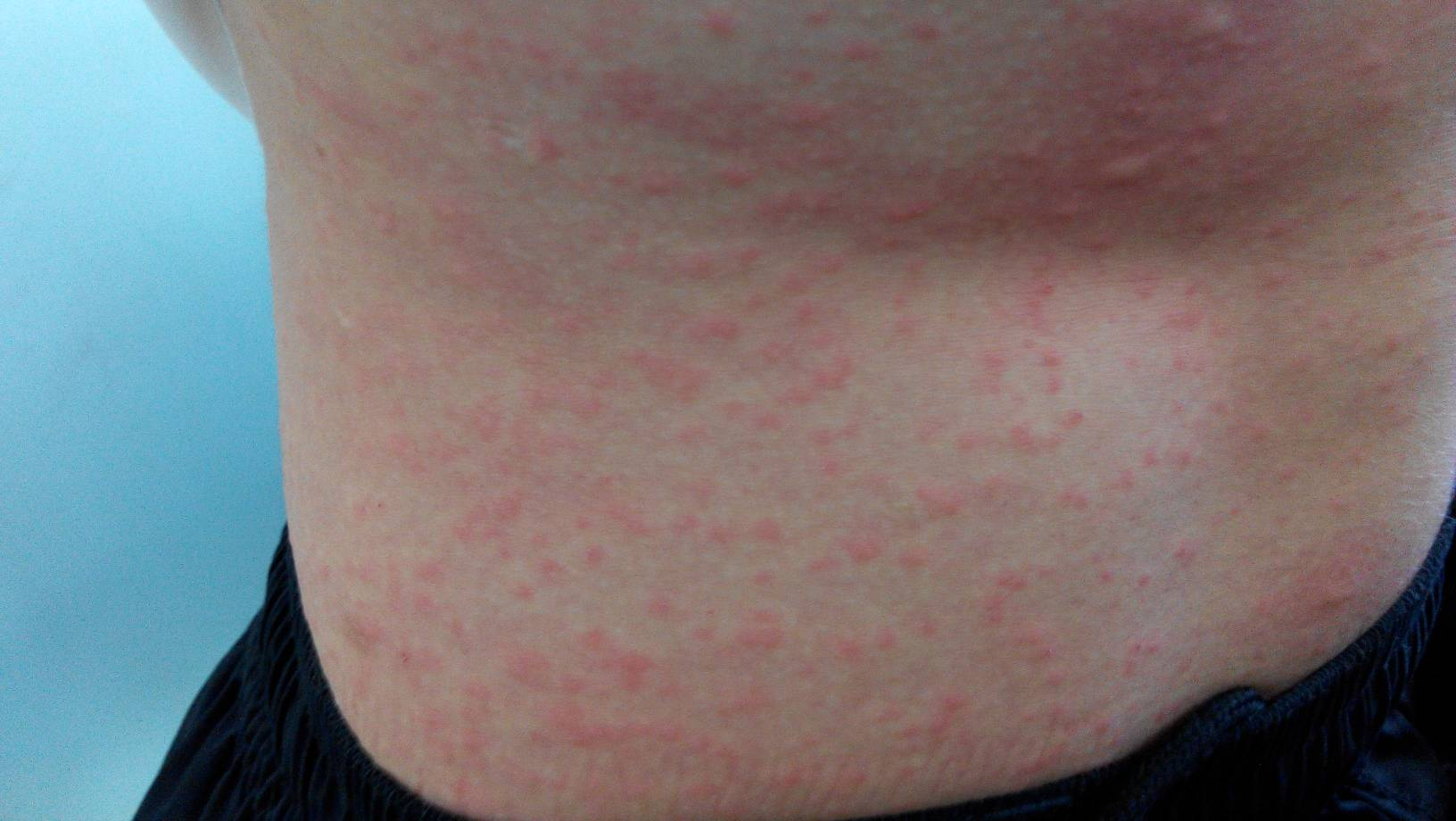 全网寻找荨麻疹患者当中的"王者"荨麻疹!