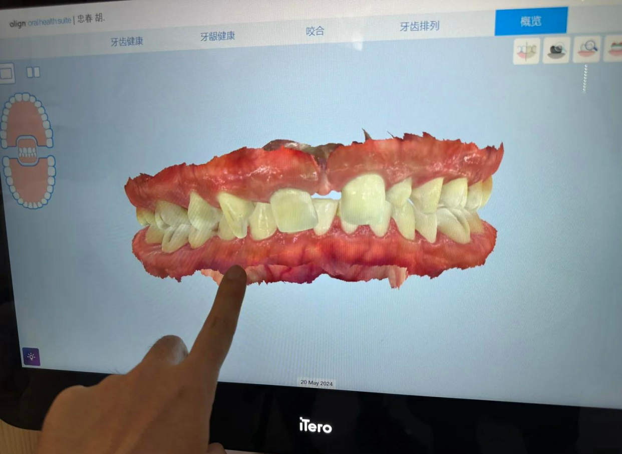 3D口扫：牙齿矫正的未来技术