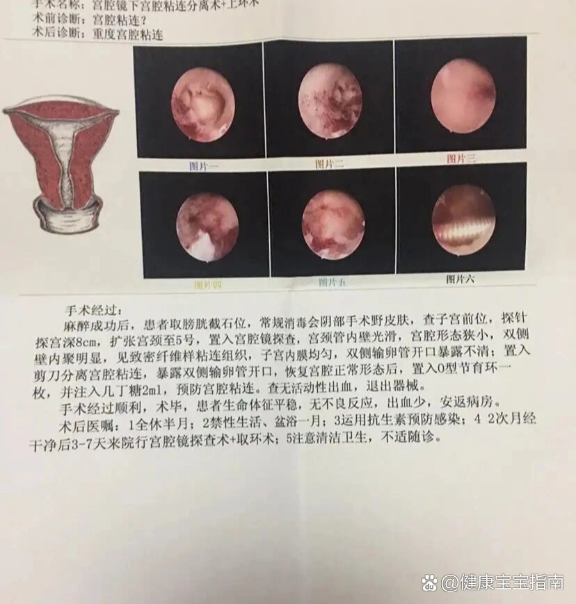 宫腔粘连的"我"还能怀孕吗?