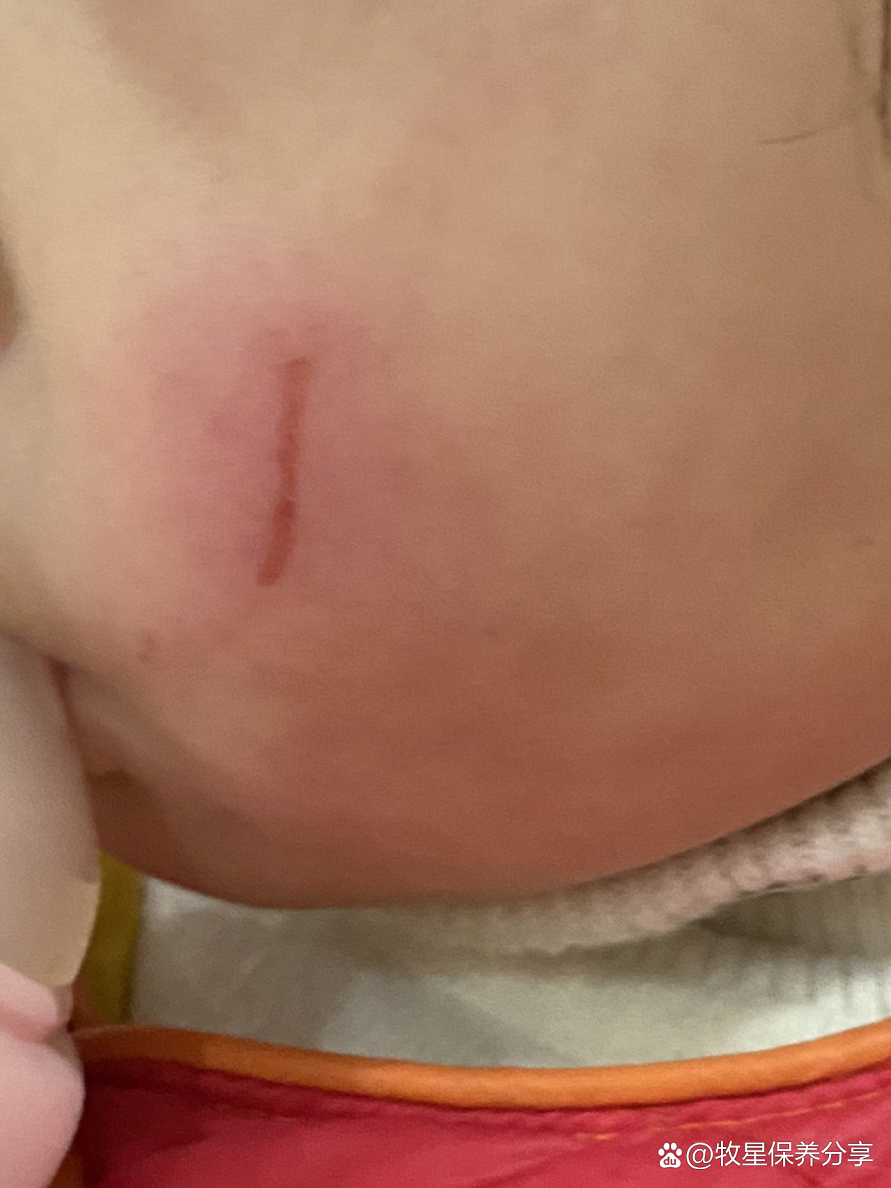 宝宝脸部被指甲刮伤