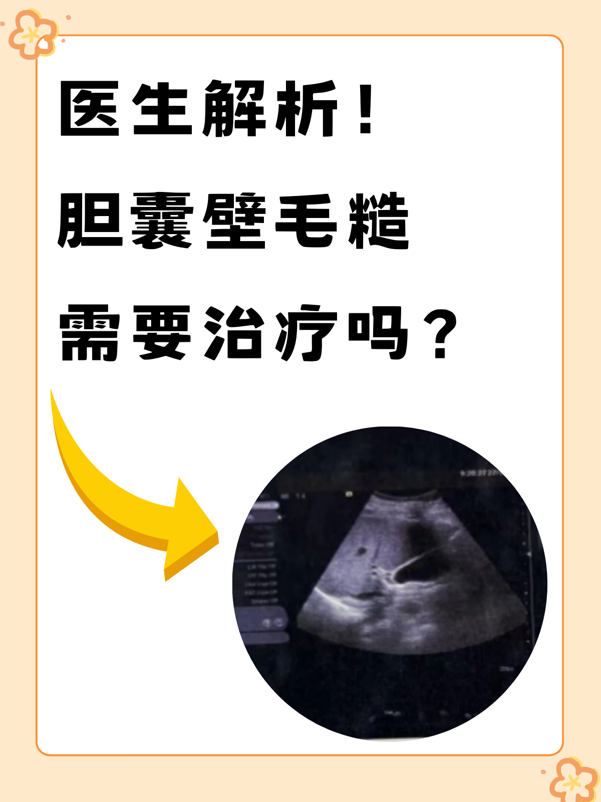 医生解析!胆囊壁毛糙需要治疗吗?
