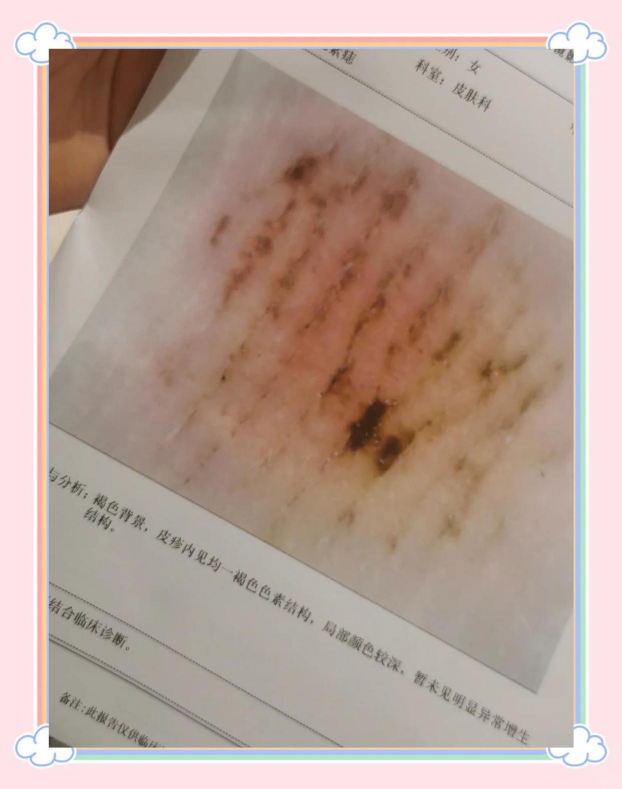 足底痣：别急着切，先看看医生怎么说