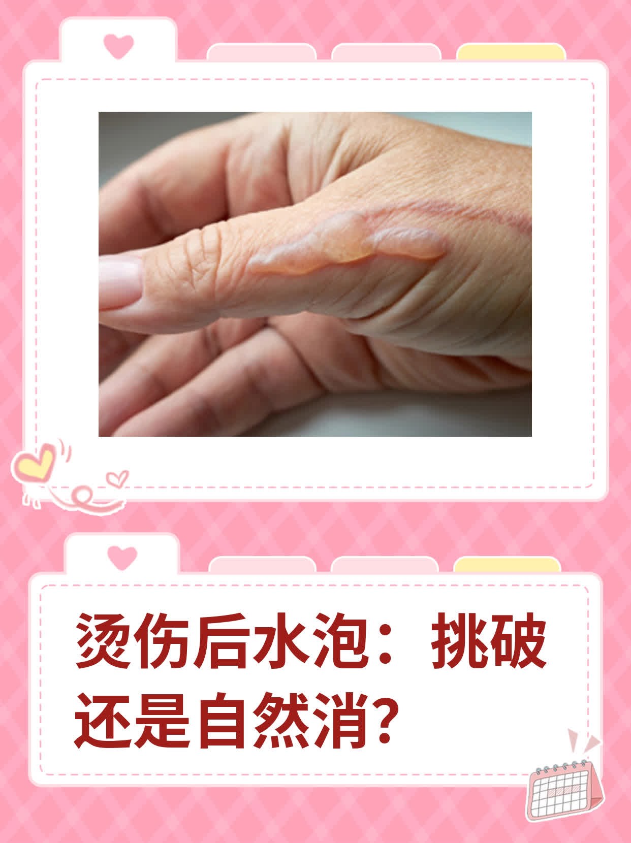 烫伤后水泡:挑破还是自然消