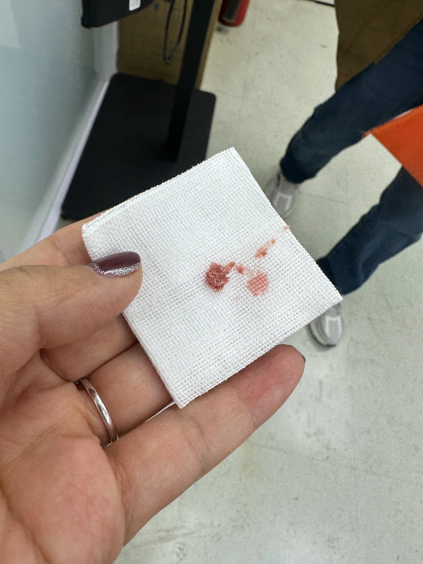 1岁宝宝毛母质瘤手术终做好了
