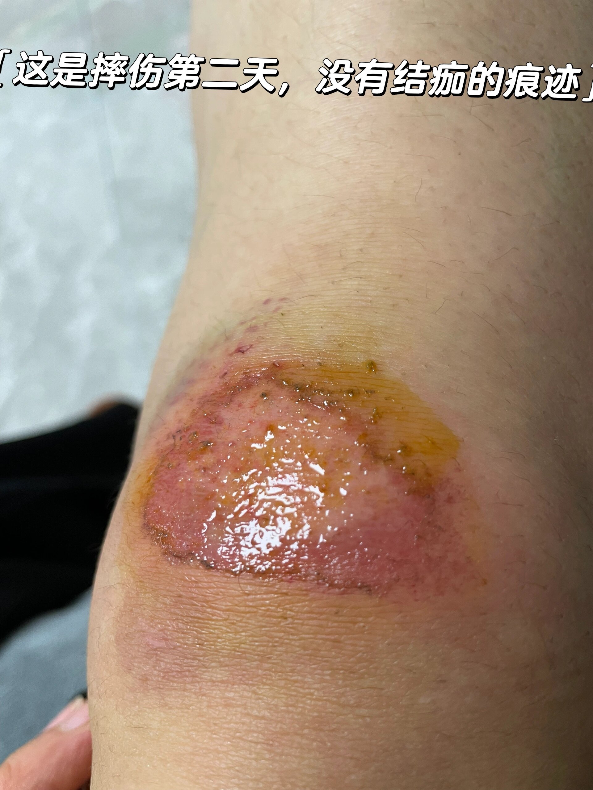 外伤正确处理方法