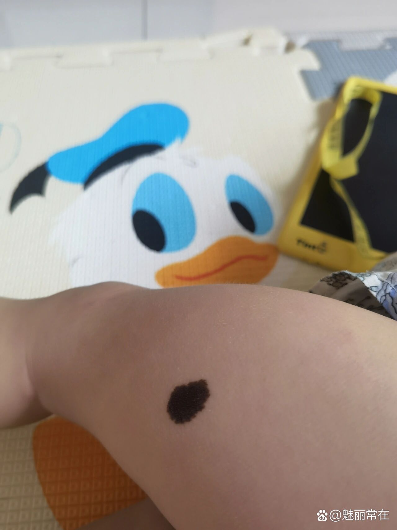 宝宝大腿有个黑色胎记去哪里弄掉