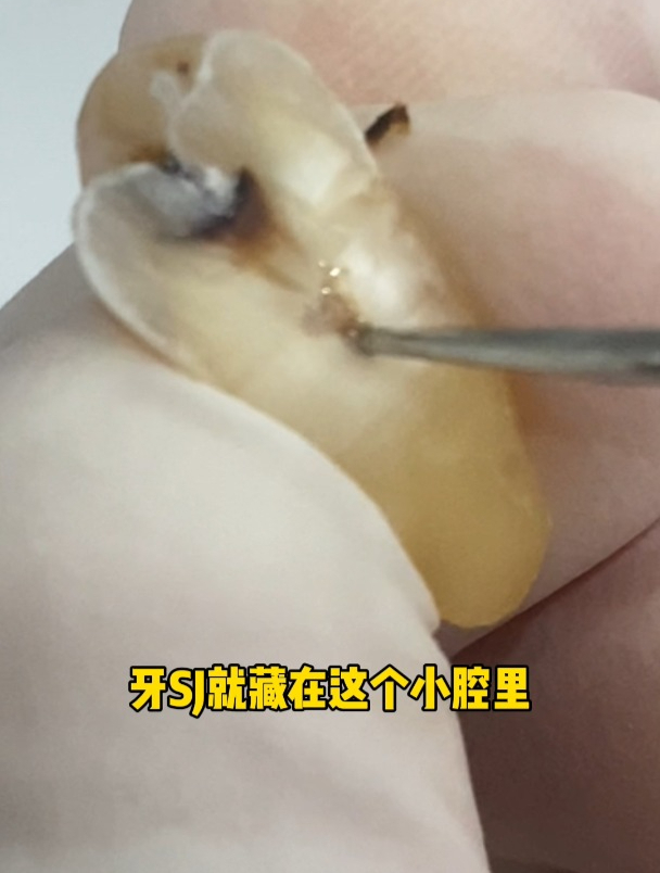 把牙劈开一半,看看牙神经长什么样!