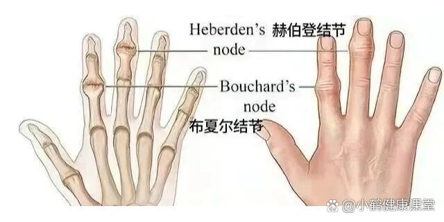 Heberden结节图片