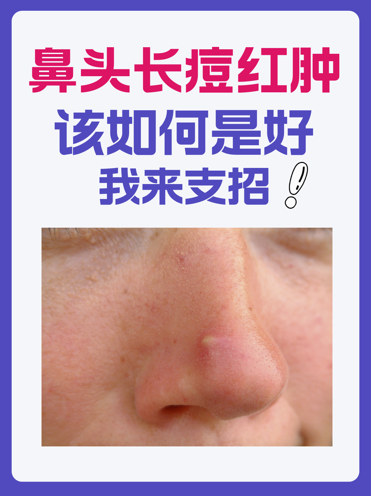 鼻头长痘红肿该如何是好?我来支招!