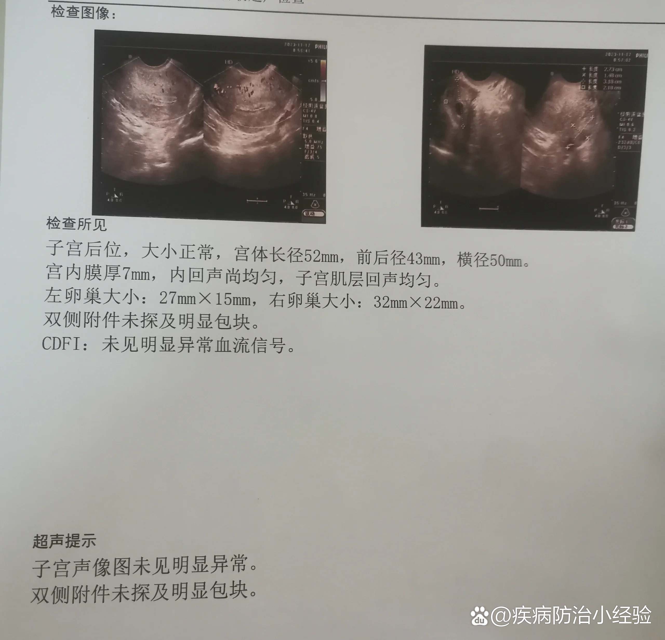 流出挺多血块的 br>月经干净后复查b超,残留不在啦 br>只是内膜有点偏