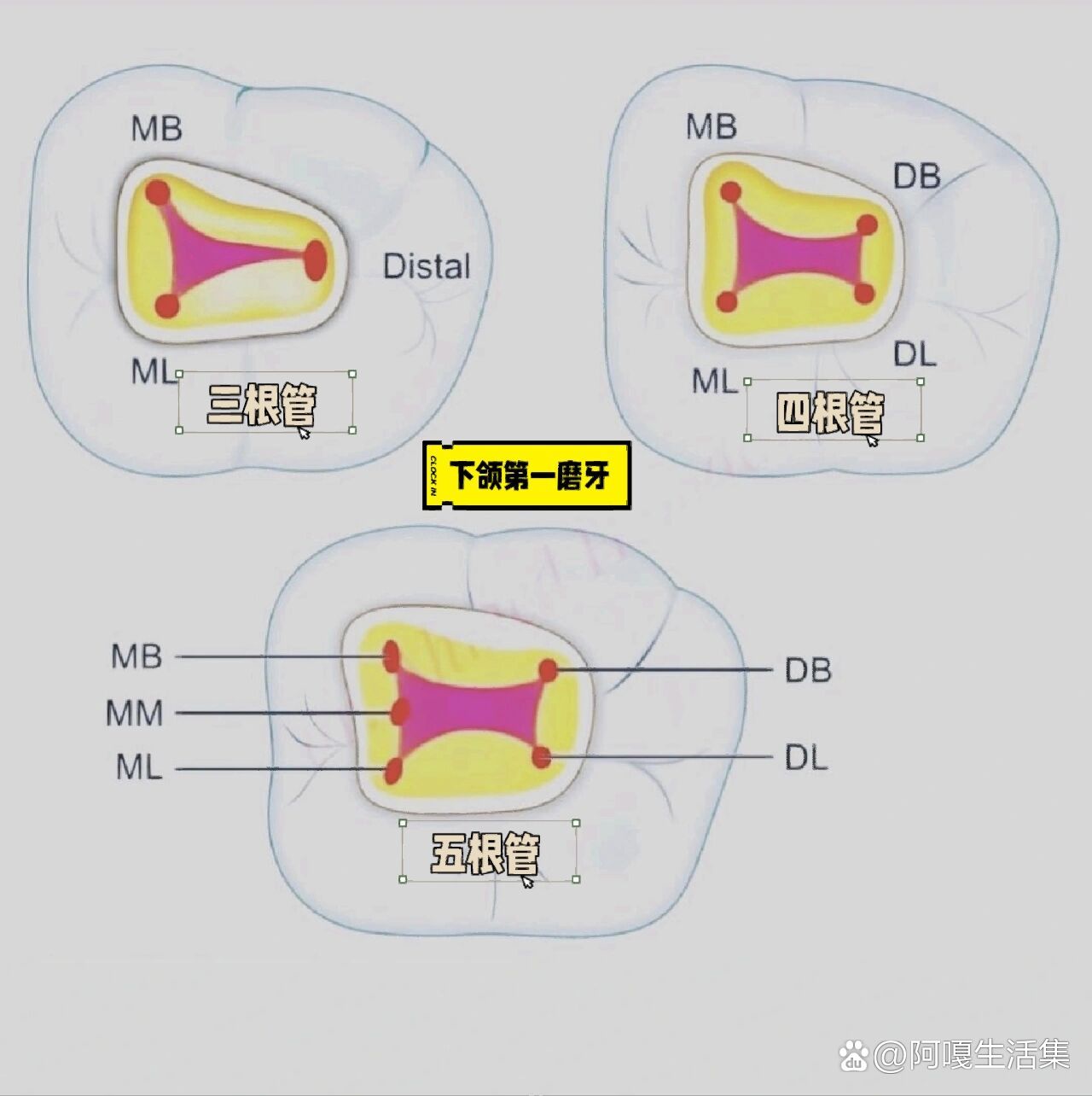 下颌第一磨牙,三根管,四根管,五根管