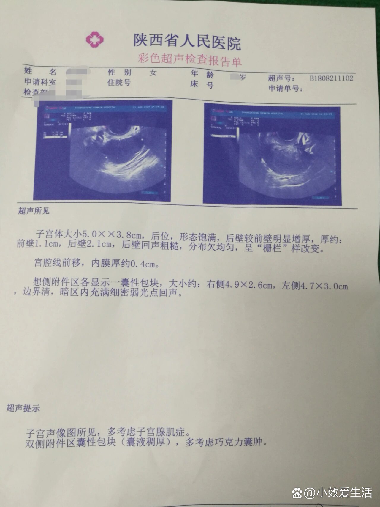 双侧巧囊图片