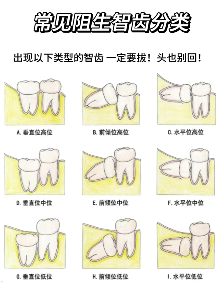 智齿阻生分类示意图图片