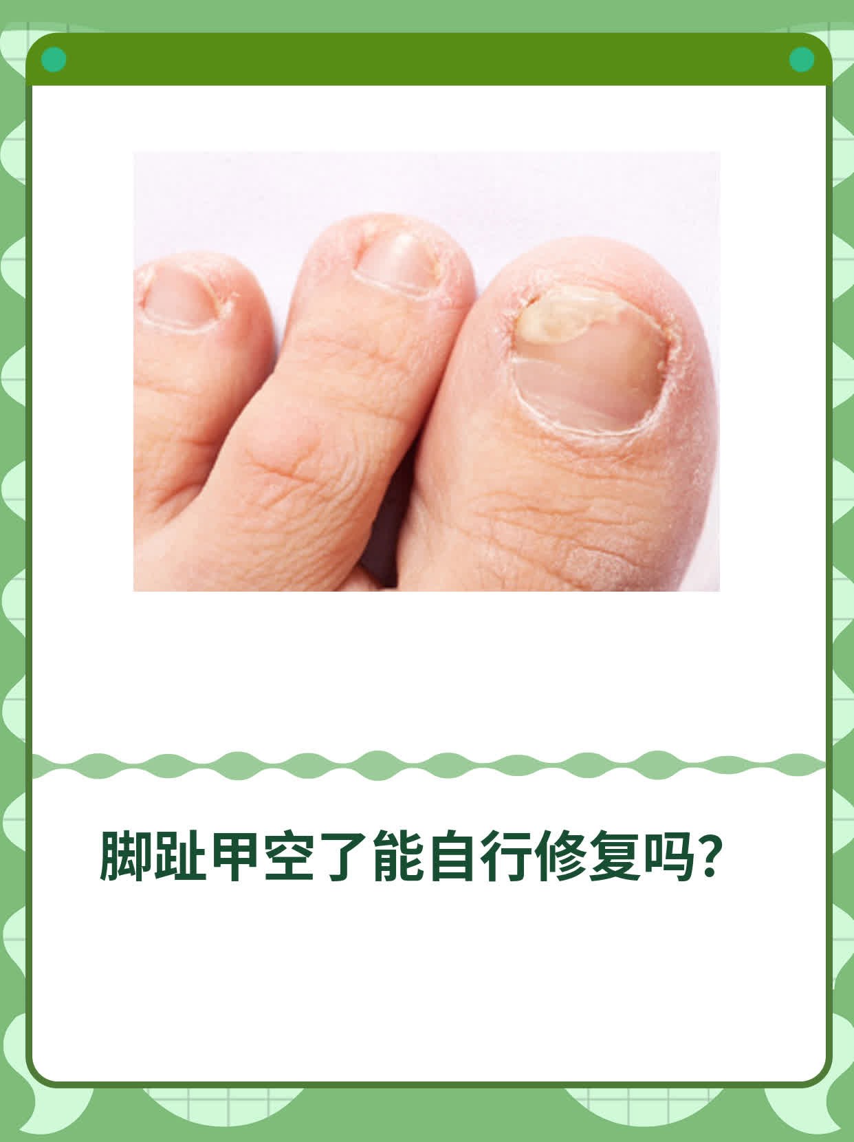 他那可爱的右脚大拇哥指甲竟然变得脆弱不堪,还出现了空洞,让他走路都