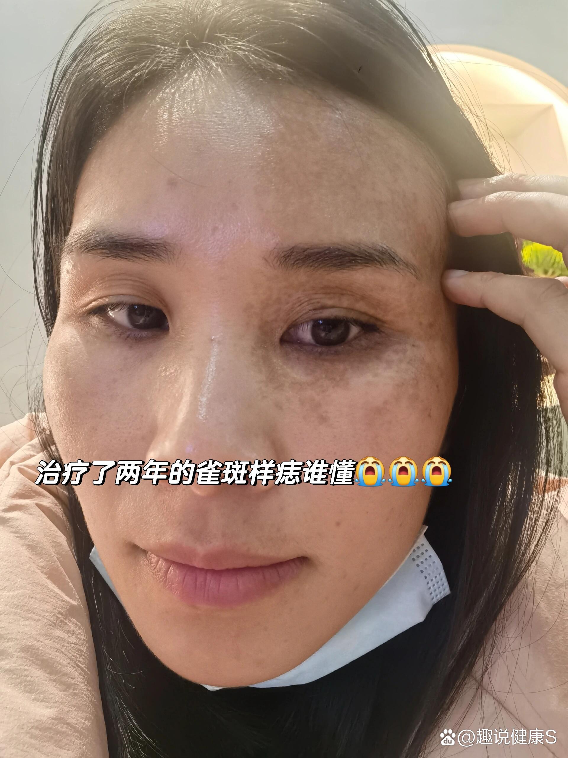 治疗了两年的雀斑样痣98医生劝我放弃治疗