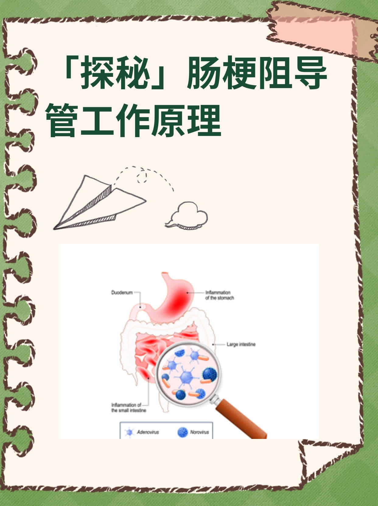 肠梗阻导管 工作原理图片