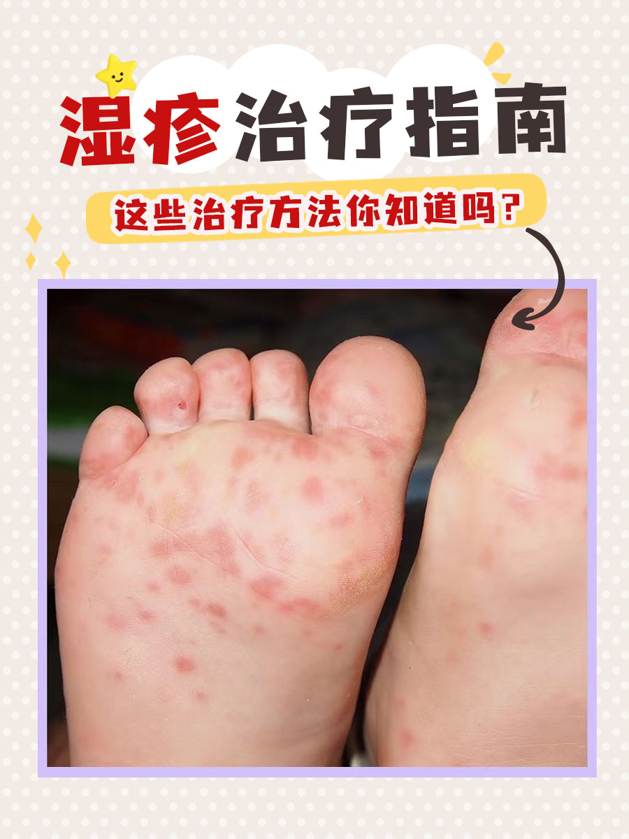 湿疹治疗指南,这些治疗方法你知道吗?