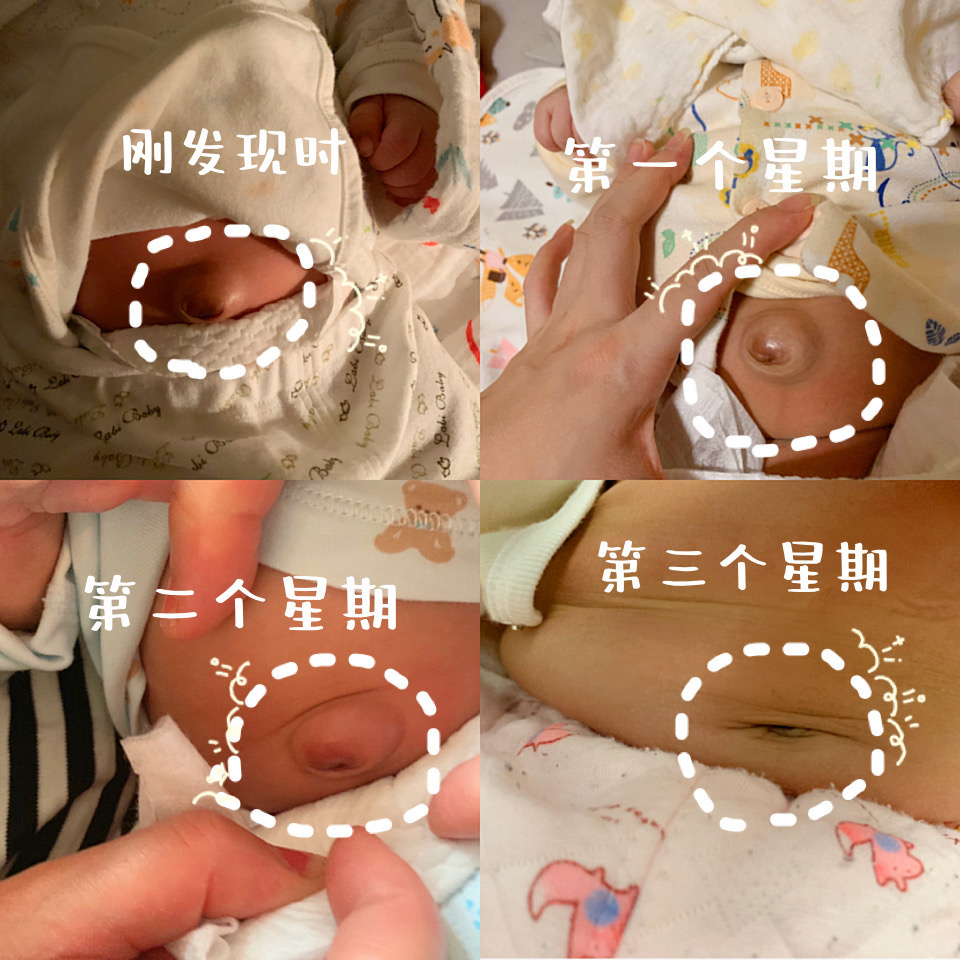 脐疝解决方法~ br>新手妈妈们不用太担心 br>脐疝又称为气肚脐,是
