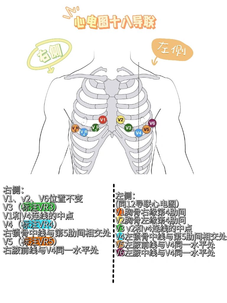 心电图18导联怎么做图片