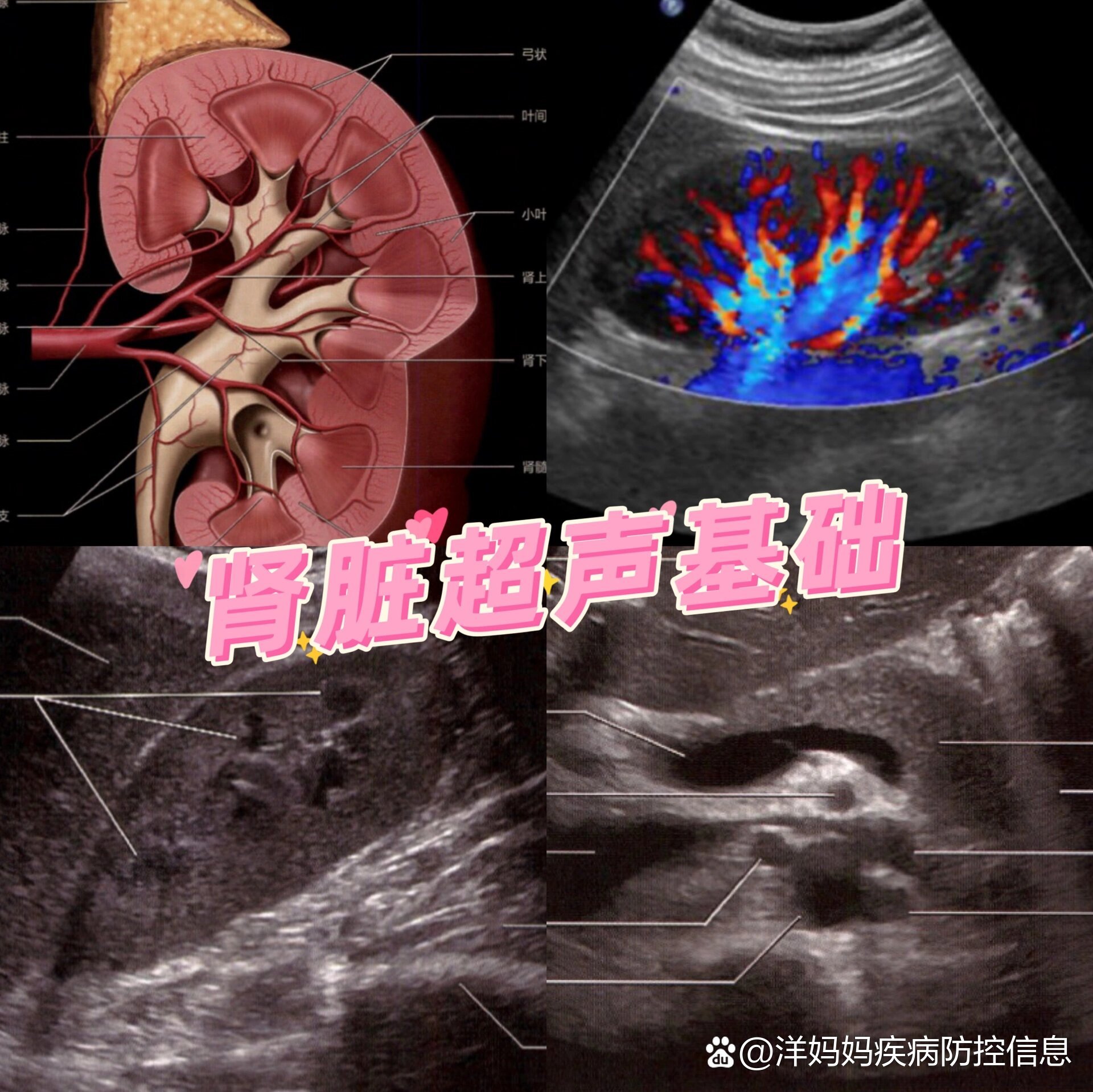 融合肾超声图片图片