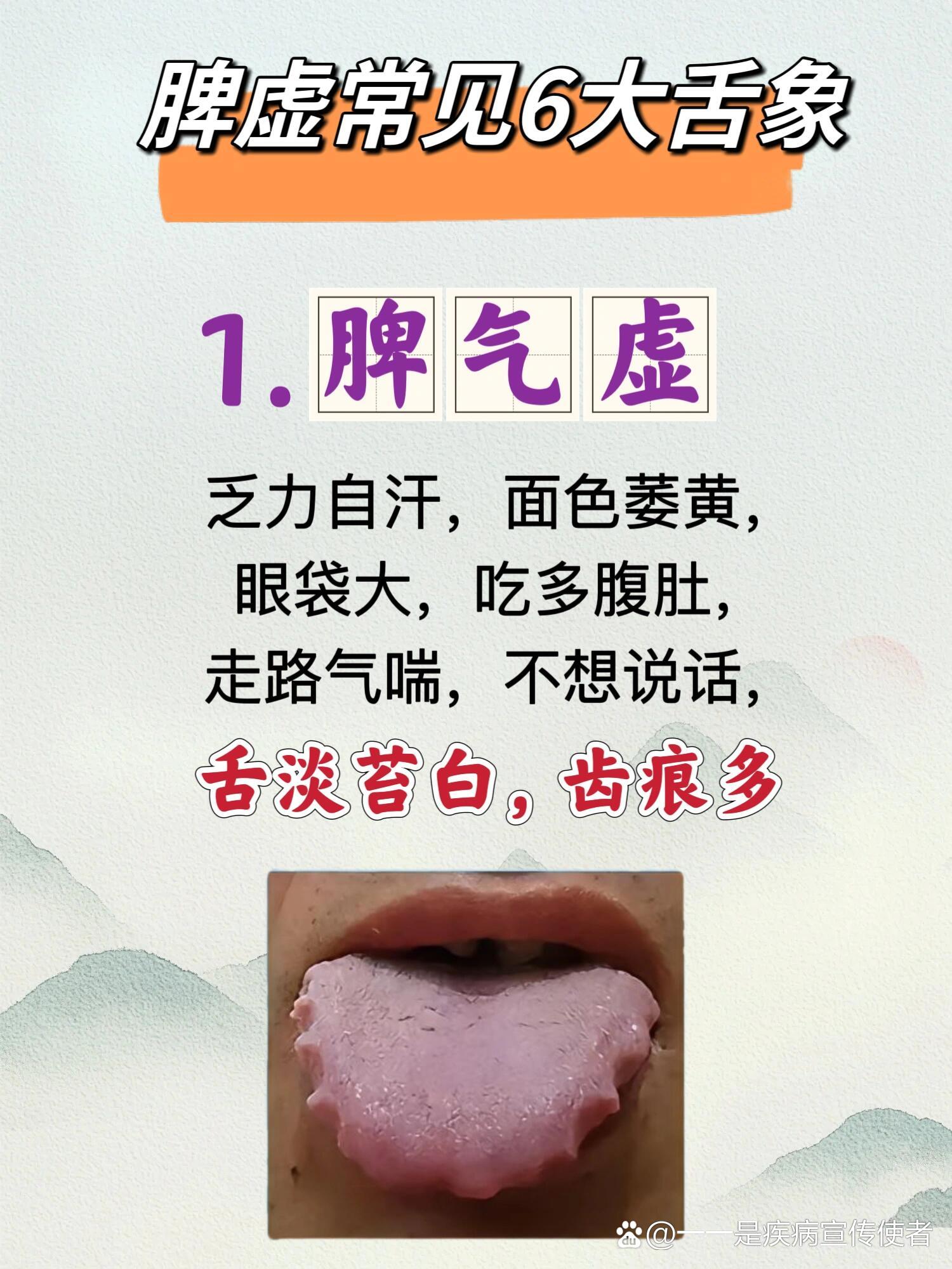 脾虚常见6大舌象