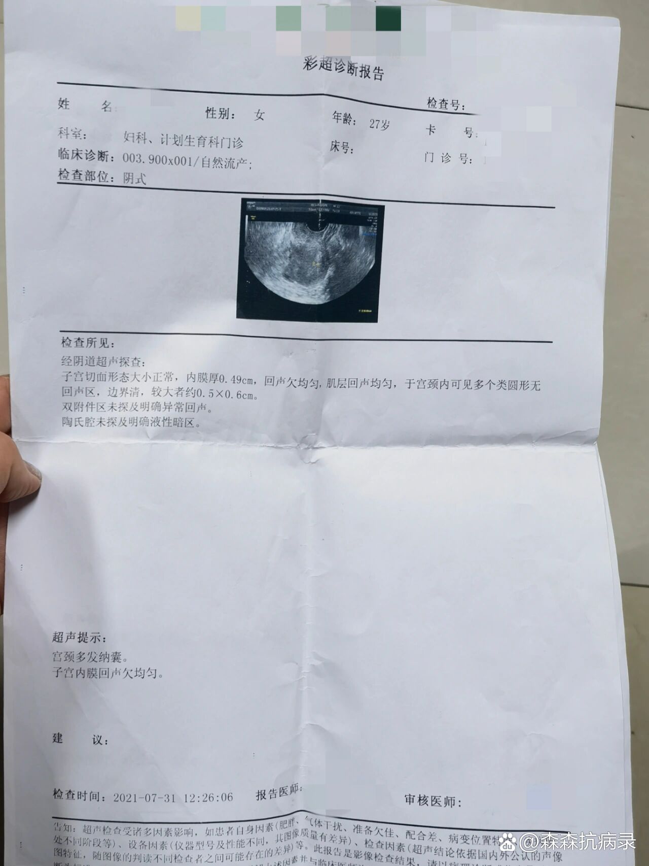 自然流产