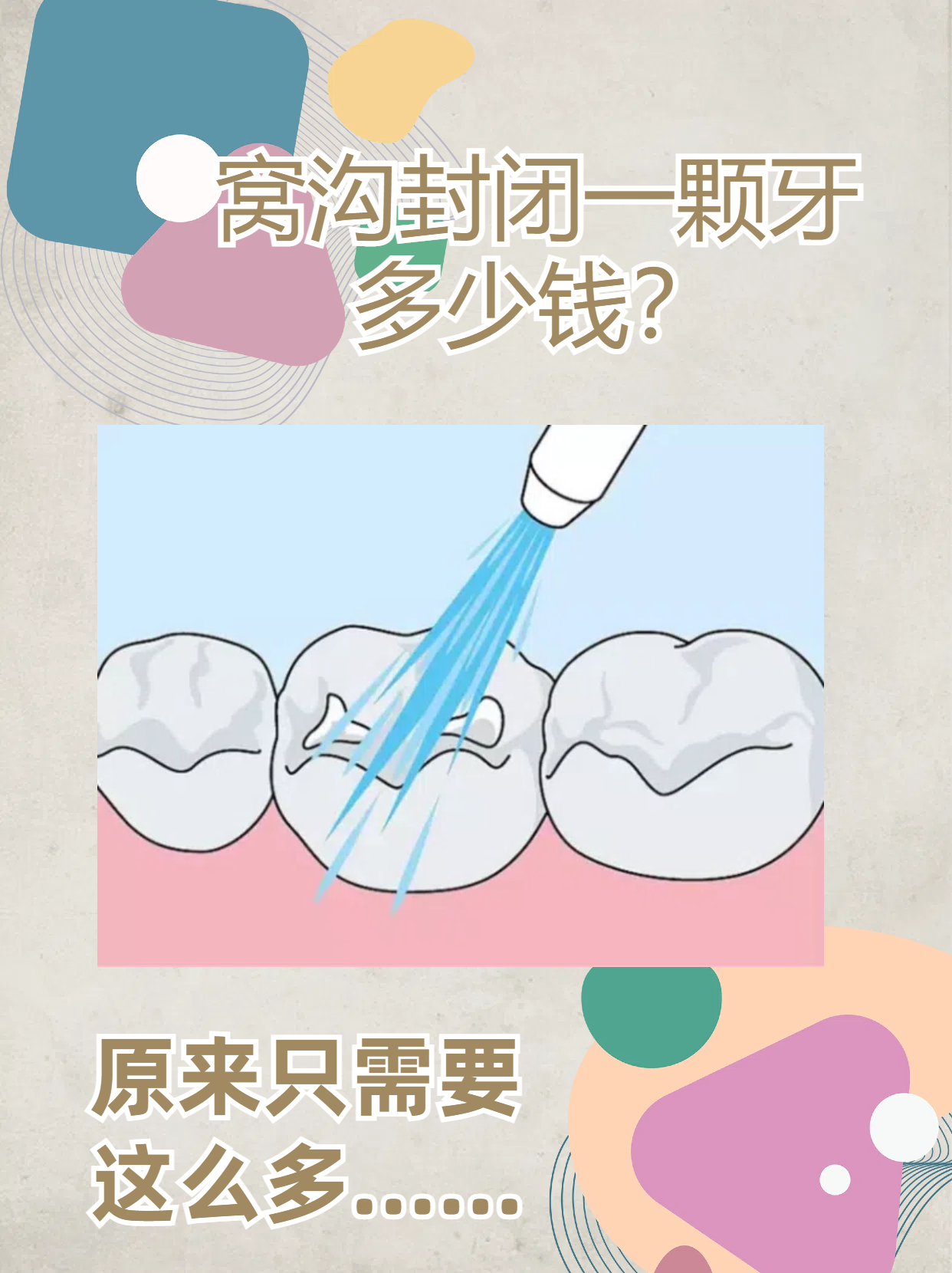 窝沟封闭多少钱图片