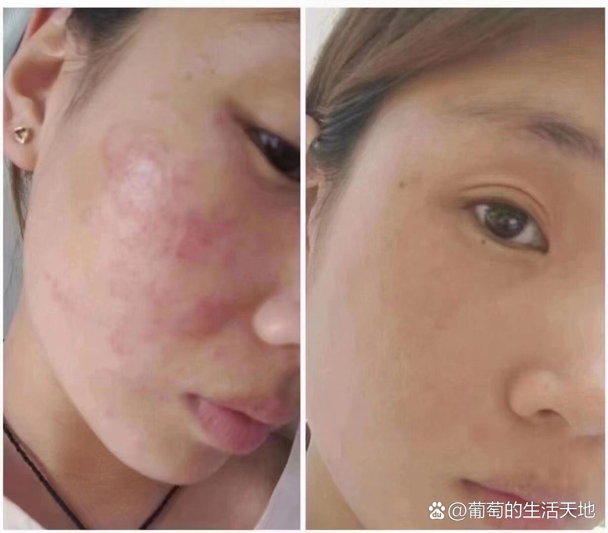 脸上为什么会蜕皮怎么回事百科在线